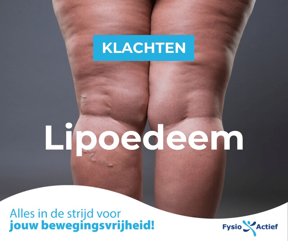 Foto van vrouwenbenen van de achterzijde waarbij lipoedeem zichtbaar is